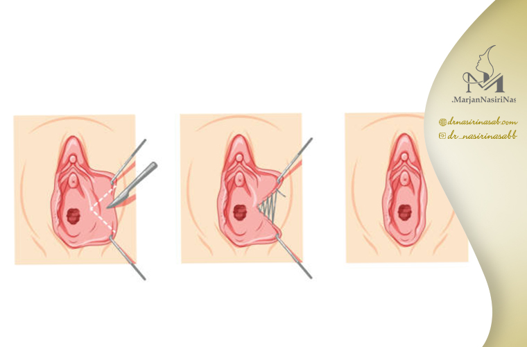 چگونگی انجام لابیاپلاستی