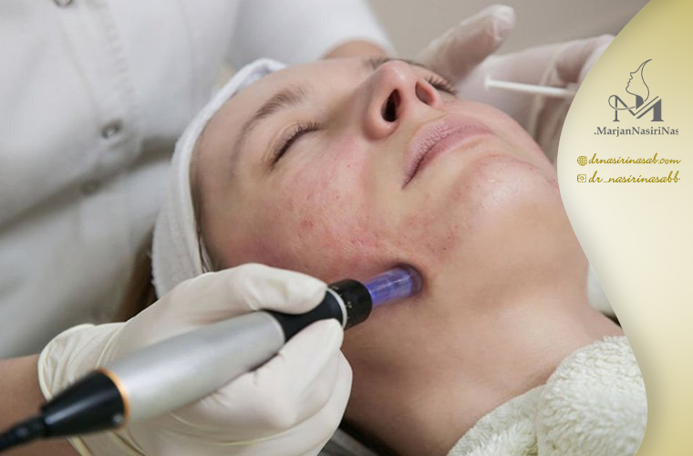 نحوه انجام میکرونیدل در کلینیک